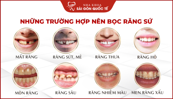 nhung_truong_hop_boc_rang_su